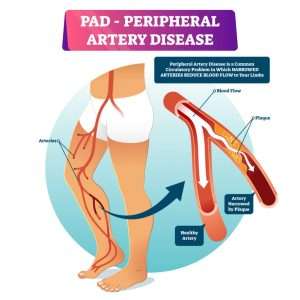 Artist-Rendering-Peripheral-Arterial-Disease-PAD-300x300-1